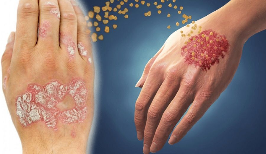 Псориаз как хроническое заболевание кожи